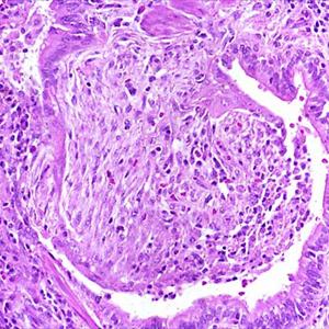 Cough And Chest Burn - An Overview Of Serious Asthmatic Bronchitis