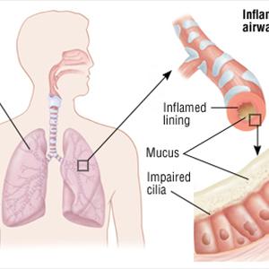 Alternative Bronchitis Remedy - Bronchitis Symptoms Signs - The Way To Recognize Them For Early Diagnosis