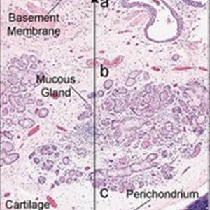 Cures For Bronchitts - Is Bronchitis Contagious? Yes And No