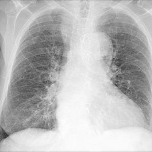 Emphysema Cures - Useful Pointers In Looking For Management Of Longterm Bronchitis