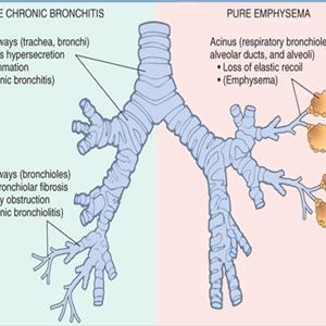Tracheal Bronchitis - Symptoms Of Bronchitis Within Newborns