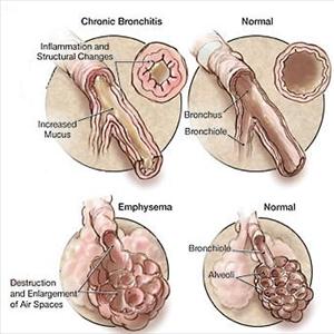  Natural Lung Health Remedy: Detox Your Lungs