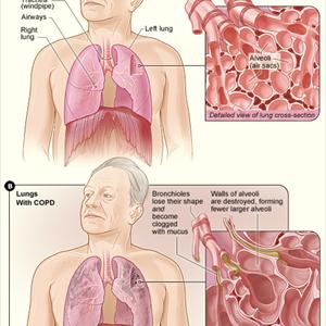 Lungs Bronchitus Ohio Natural 