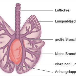 Mold Bronchitis - Lung Infections
