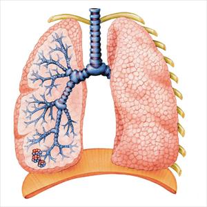 Chronic Bronchitis - Pneumonia - Causes, Signs And Symptoms And Treatment