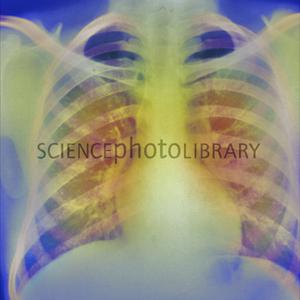  Bronchitis Therapies