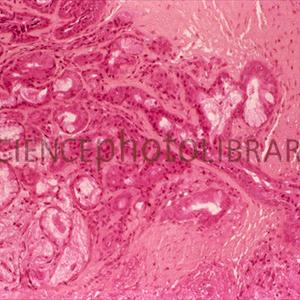 Inhaler Chronic Bronchitis - Forms And Types Of Respiratory Disease