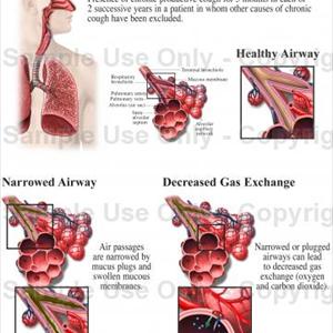 Bronchi Infection - Home Remedy Treatment Options Regarding Bronchitis