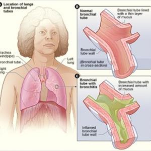 Cronicalbronquitis - Things About Bronchitis