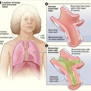 Cronicalbronquitis 