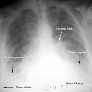  Lung Cleaning For Smokers To Avoid A Sticky Fate