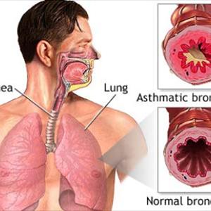 Prolonged Bronchitis Cough - Herbal Fix For Cough