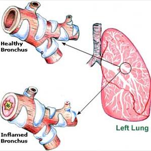 Bronchitis Spreadable - You Ought To Understand The Disease Bronchitis