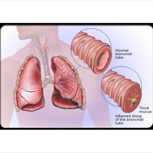 Chesty Cough Shortness Of Breath - Information Upon Bronchitis