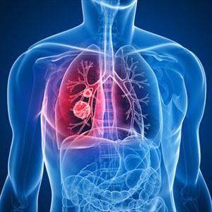 Mycoplasma Bronchitis 