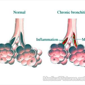 Almond Chronic Bronchitis 