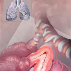 Alternative Cures For Bronchitis - Is Bronchitis Contagious? Sure And No