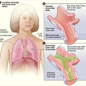 Bronchi - Symptoms Of Bronchitis And Its Particular Causes