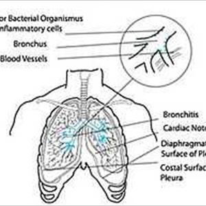 Get Rid Of Mucus Bronchitis - Bronchitis Therapies