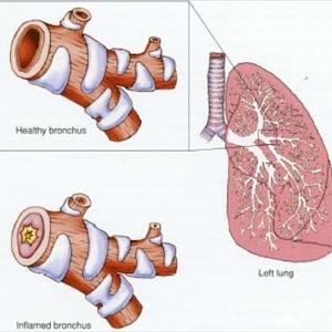 Alternative Cures For Bronchitis 