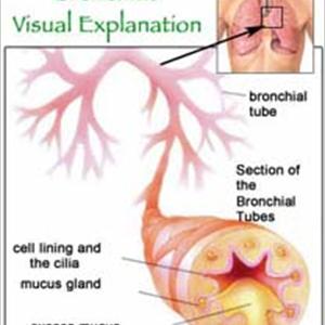 Bronchitis Blood - Various Choices For Treating Bronchititis