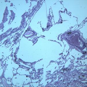 Lungs Bronchitus Ohio Natural - Children As Well As Acute Bronchitis