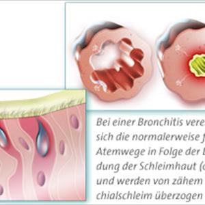 Chronic Bronchitis Treatment - COPD - The Easy Way Deal With Serious Obstructive Lung Sickness