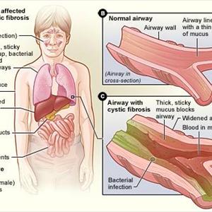 Cures For Bronchitis Cough - How Will Be Bronchitis Treated?