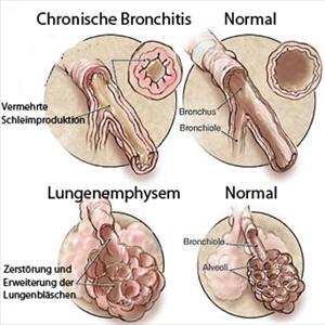 Frothy Sputum Cough 