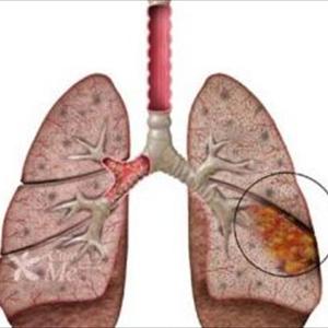  Natural Lung Well Being Remedy: Detox The Lungs