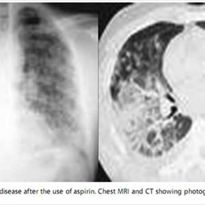  Oral Adrenal Cortical Steroids With Regard To COPD