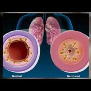  What Is Bronchitis And How To Stay Away From It?